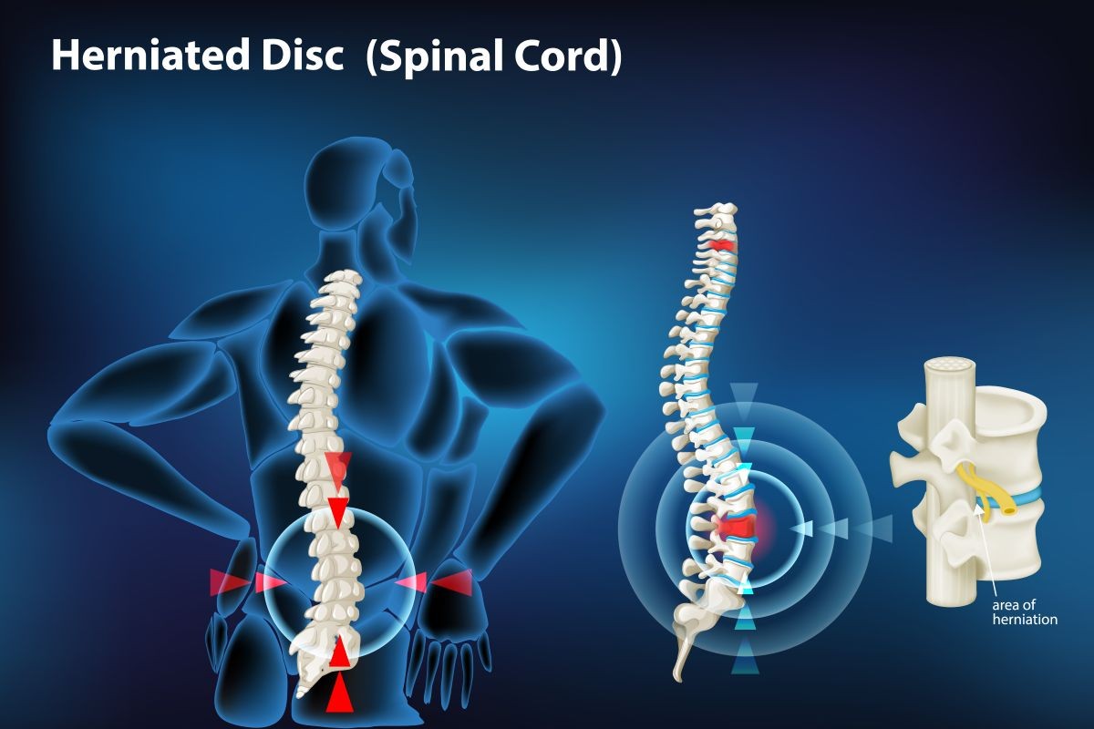 Bulging and Herniated Discs