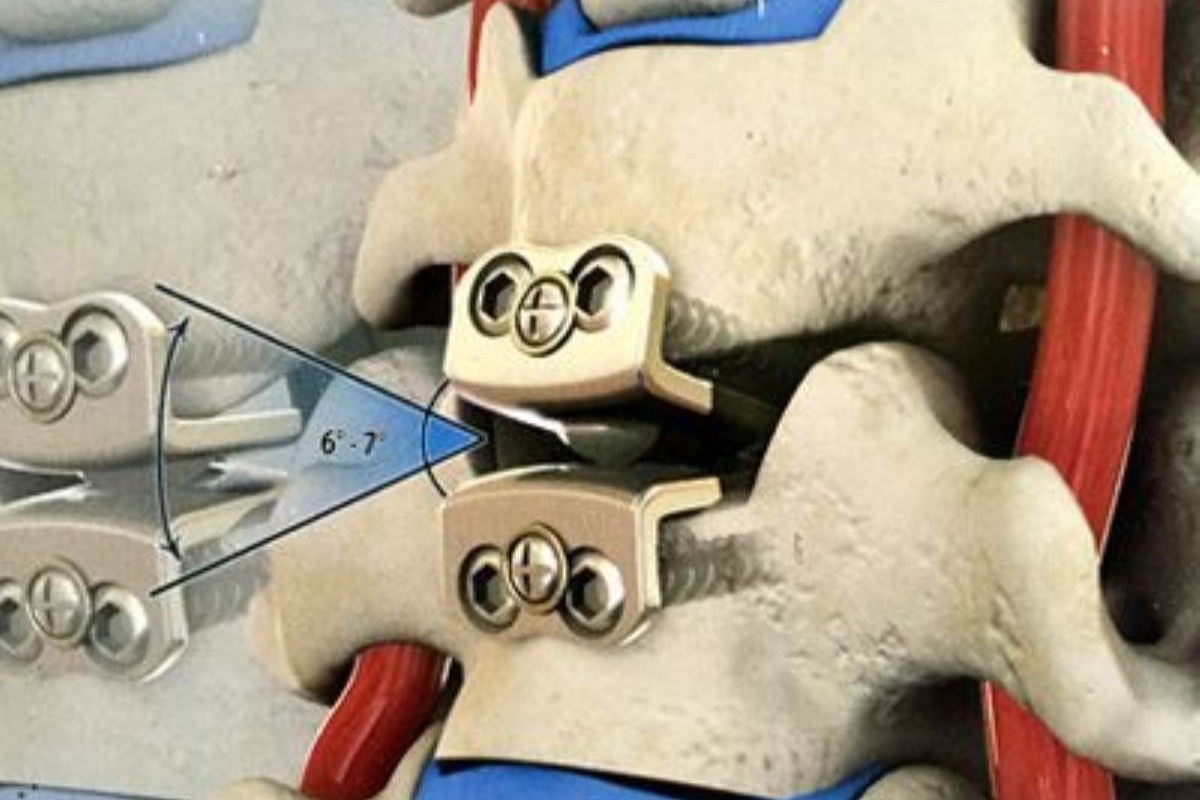 Cervical Artificial Disc Replacement