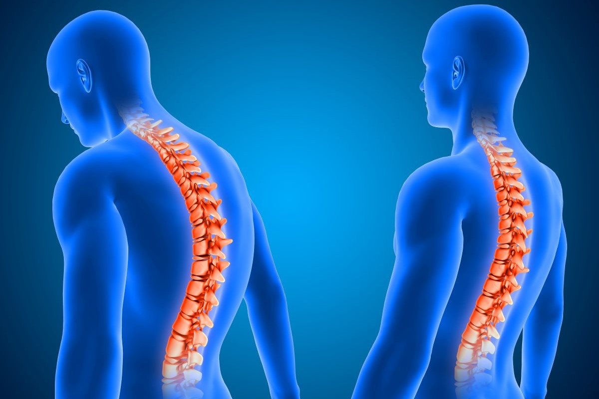 Kyphoscoliosis