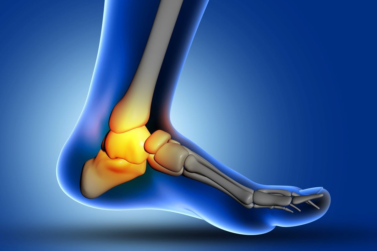 Bone Spurs