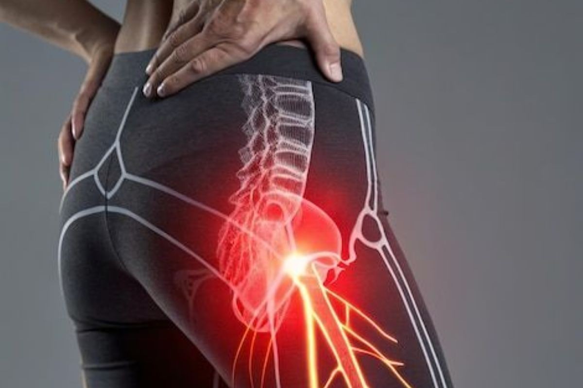 Sciatica