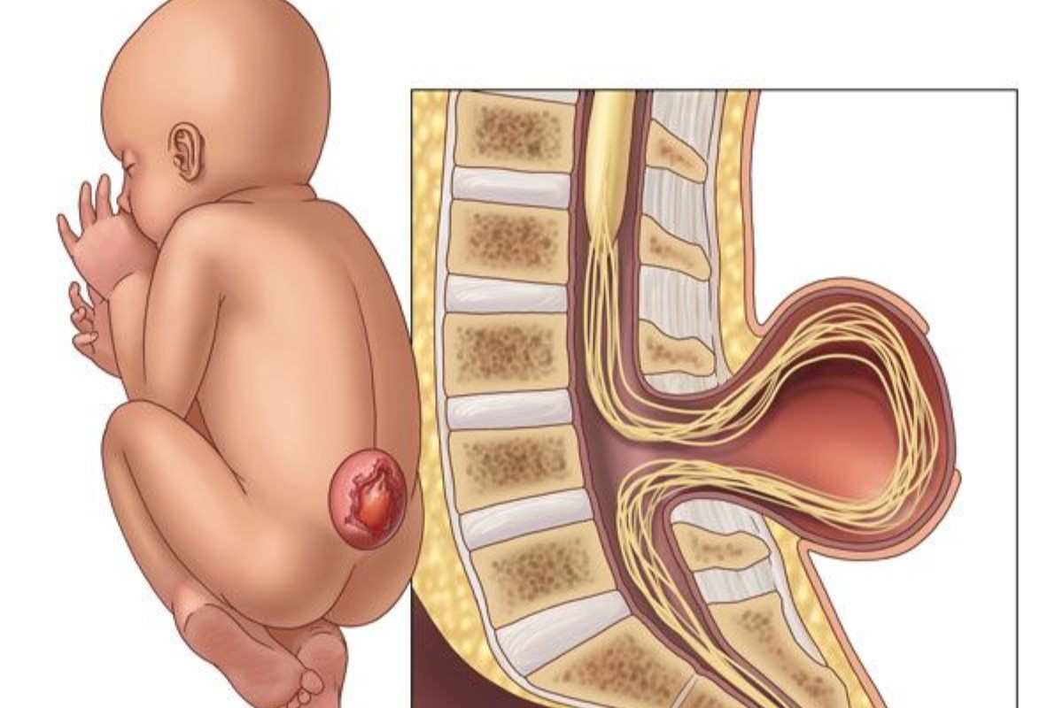 Paediatric Spine Diseases
