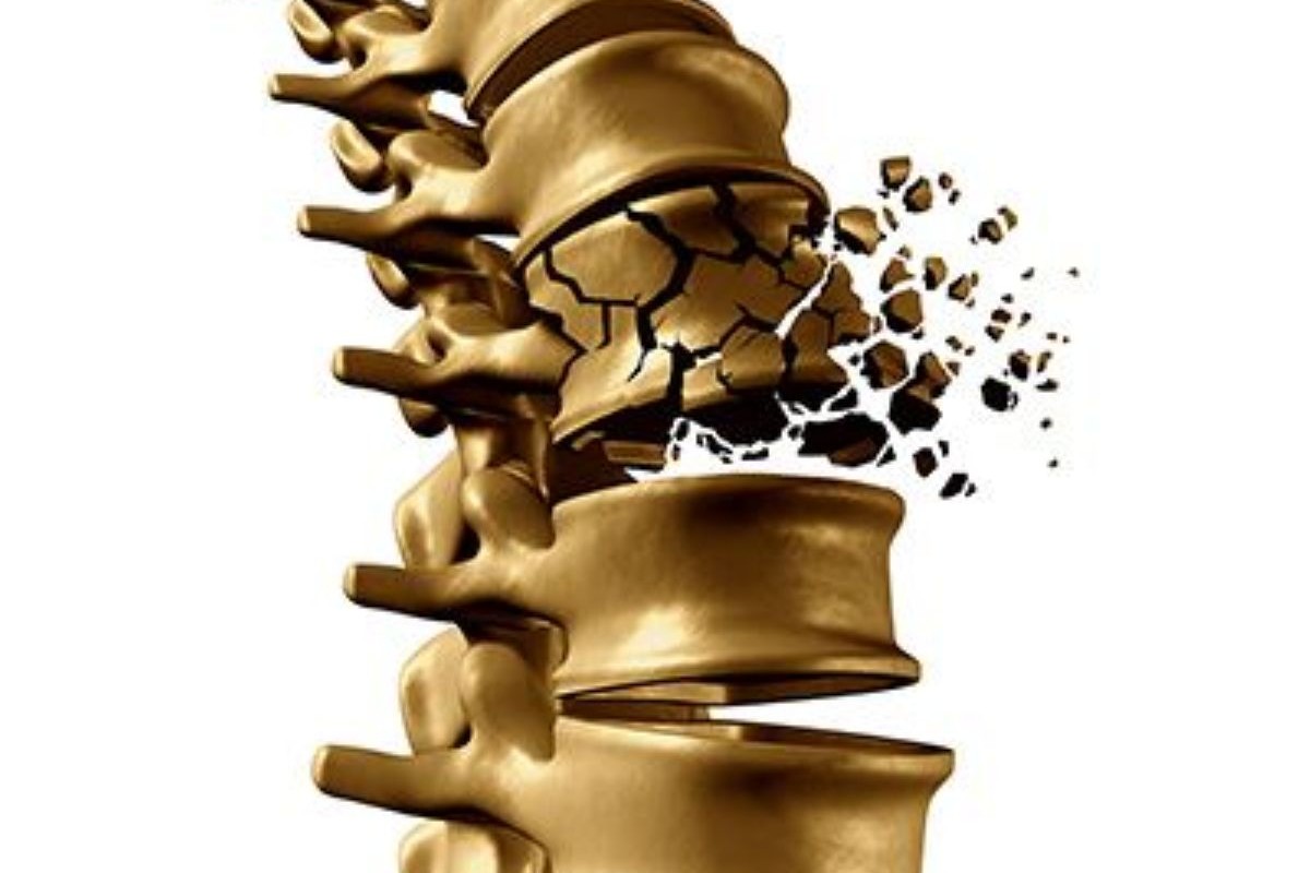 Vertebral Fractures