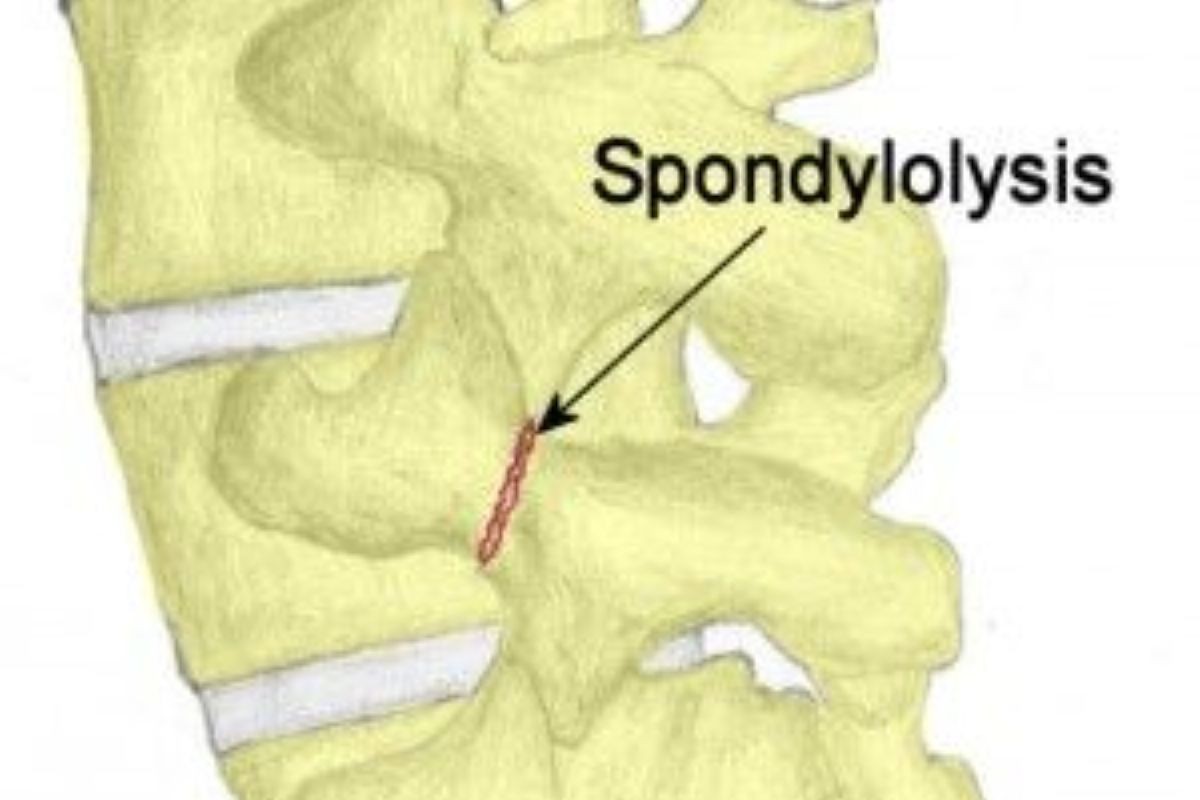 Spondylodiscitis