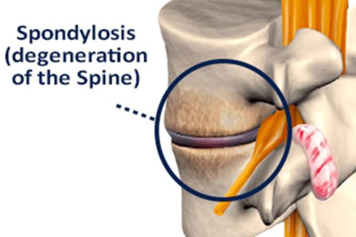 Lumbar Spondylosis