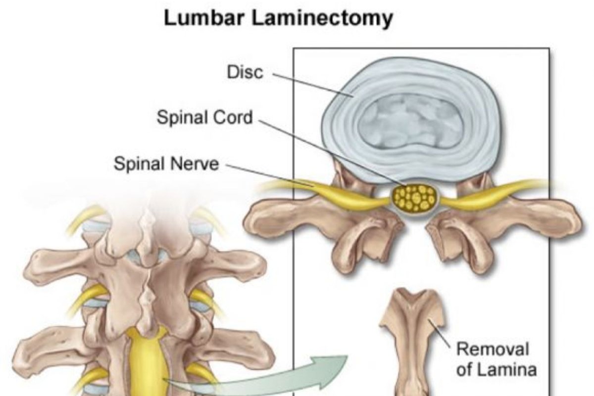 Thoracic Laminectomy